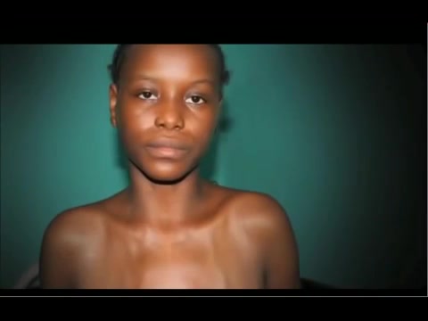 Anglique: une Congolaise aux seins enormes qui psent 20Kg